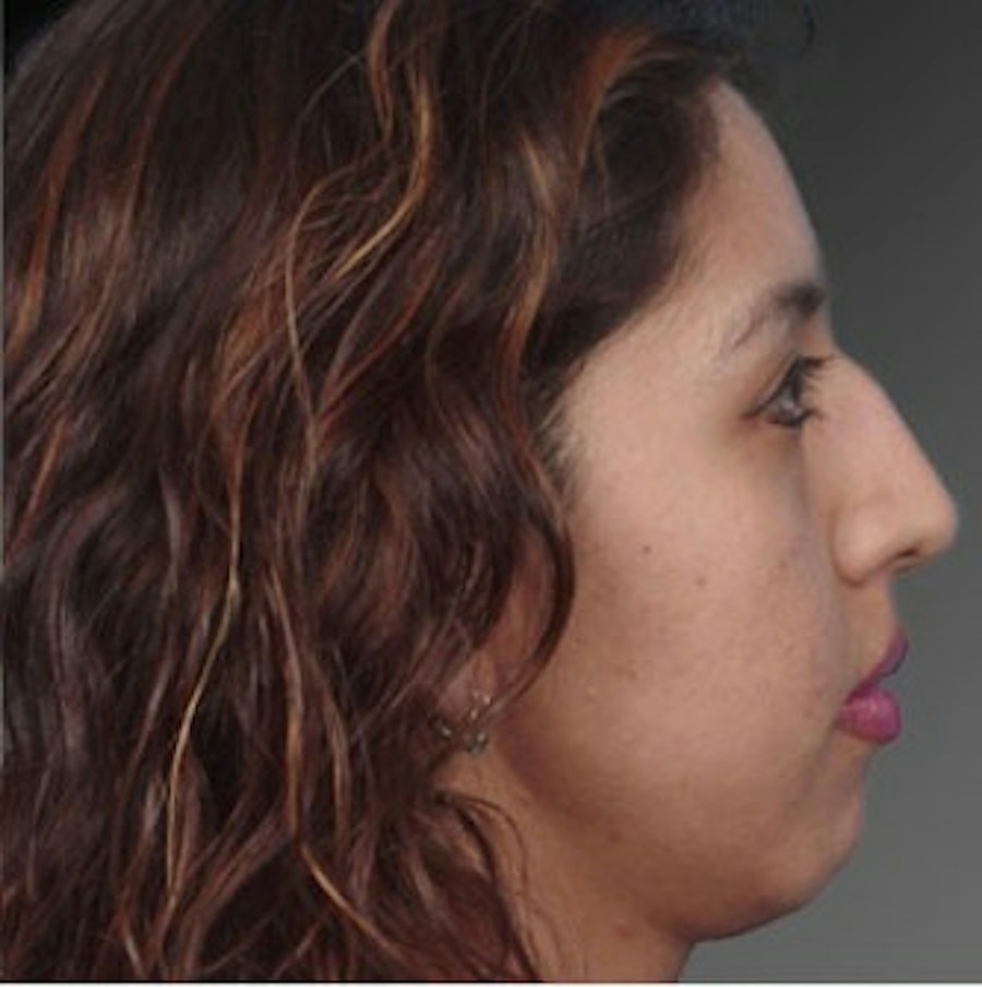 Patient 106009308 | Profile View | Before | Rhinoplasty — Steven Teitelbaum MD -