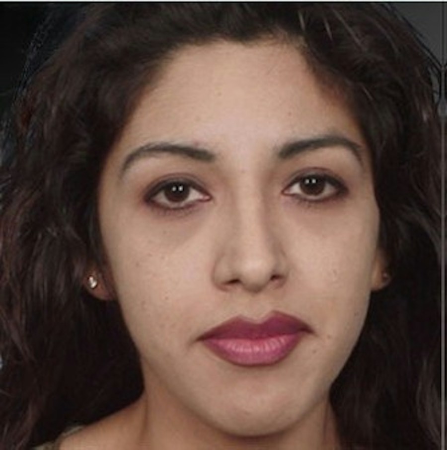 Patient 106009308 | Front View | After | Rhinoplasty — Steven Teitelbaum MD -