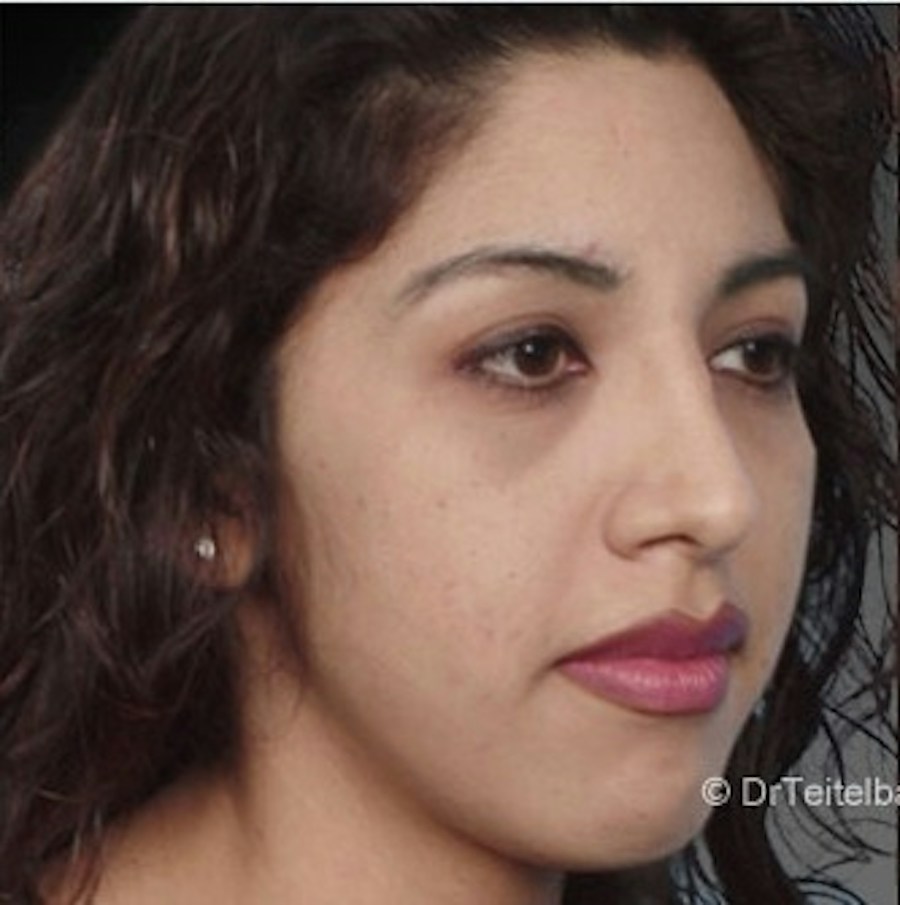 Patient 106009308 | Angle View | After | Rhinoplasty — Steven Teitelbaum MD -
