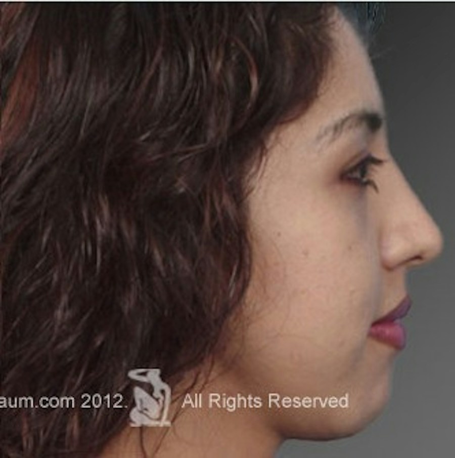 Patient 106009308 | Profile View | After | Rhinoplasty — Steven Teitelbaum MD -