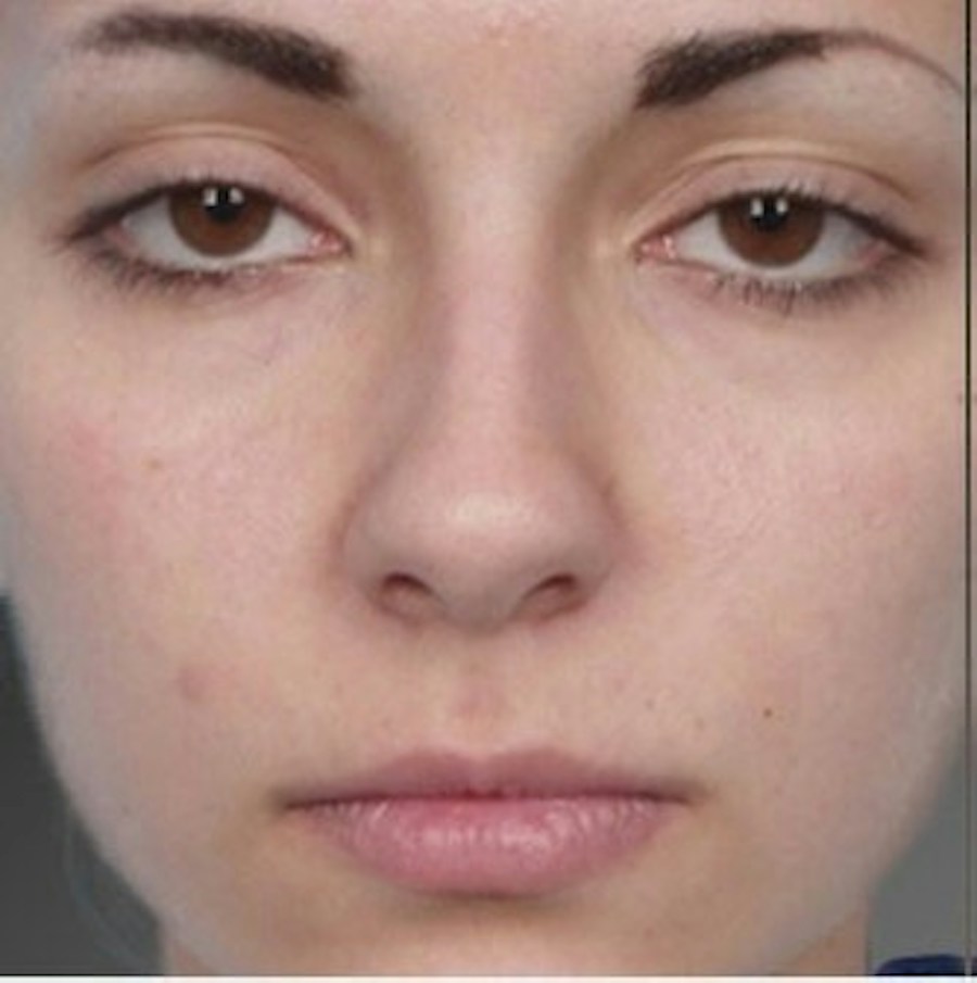 Patient 106009310 | Front View | Before | Rhinoplasty — Steven Teitelbaum MD -