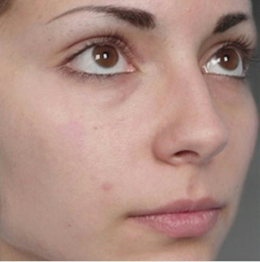 Patient 106009310 | Angle View | Before | Rhinoplasty — Steven Teitelbaum MD -