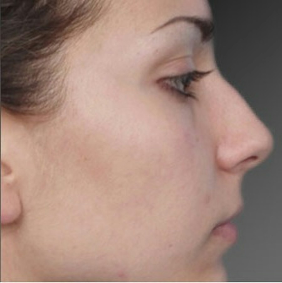Patient 106009310 | Profile View | Before | Rhinoplasty — Steven Teitelbaum MD -
