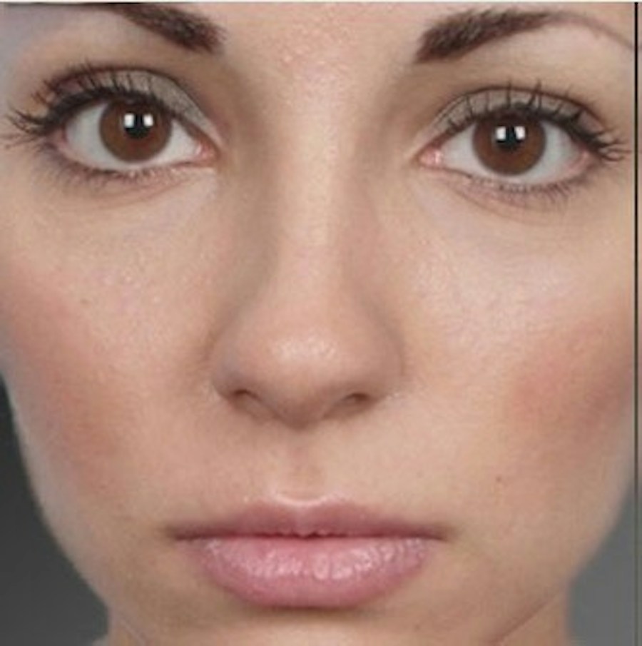 Patient 106009310 | Front View | After | Rhinoplasty — Steven Teitelbaum MD -