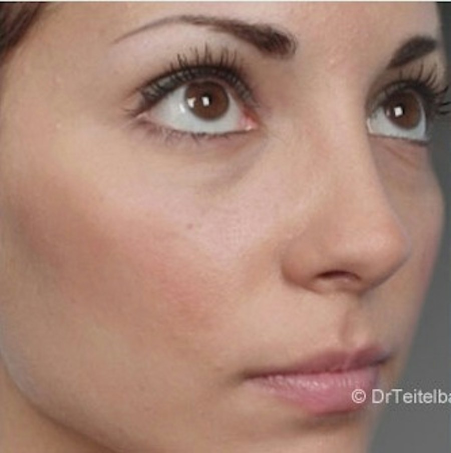 Patient 106009310 | Angle View | After | Rhinoplasty — Steven Teitelbaum MD -