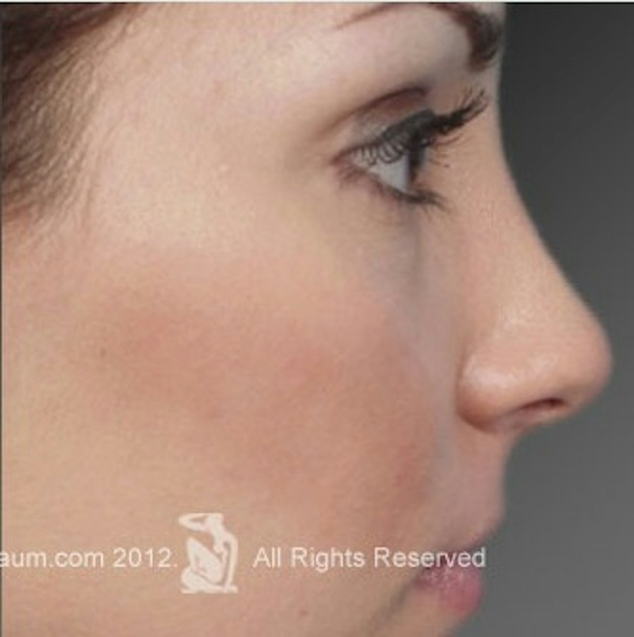 Patient 106009310 | Profile View | After | Rhinoplasty — Steven Teitelbaum MD -