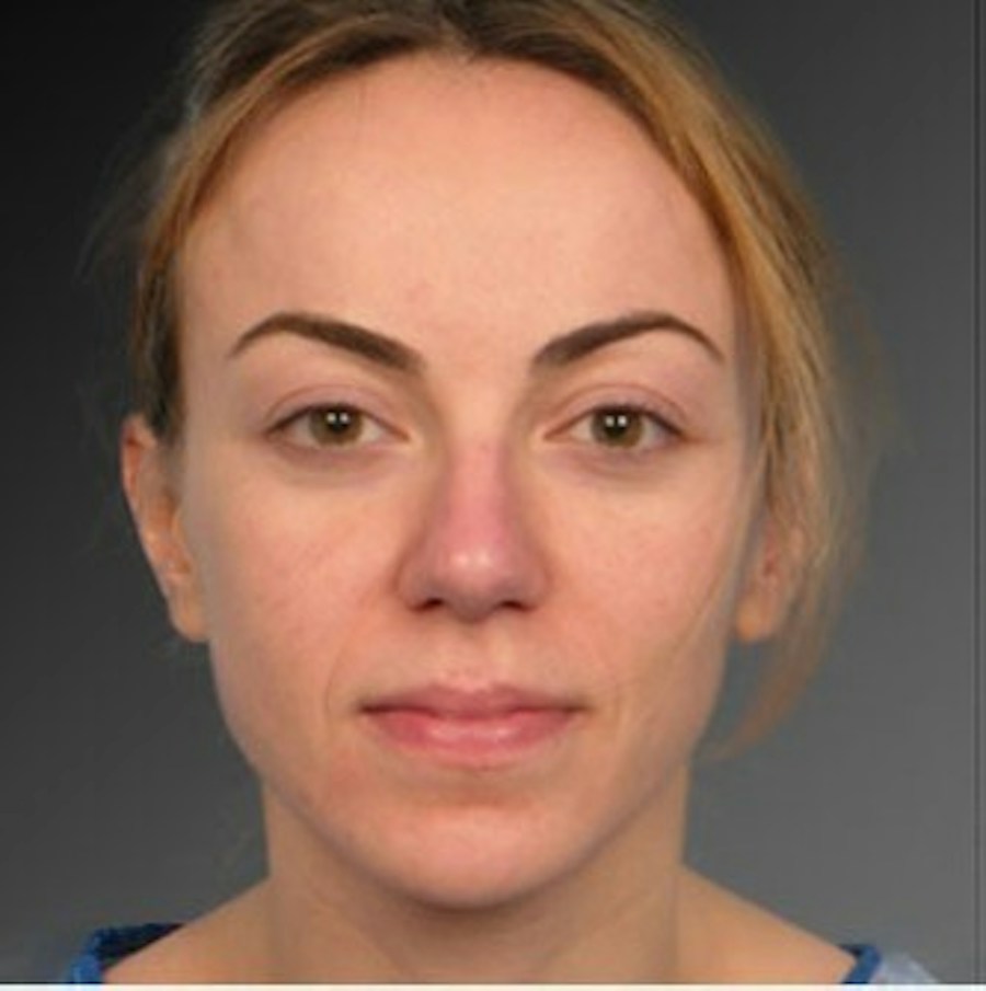 Patient 106009312 | Front View | Before | Rhinoplasty — Steven Teitelbaum MD -