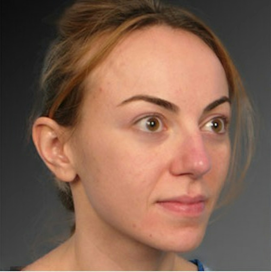 Patient 106009312 | Angle View | Before | Rhinoplasty — Steven Teitelbaum MD -