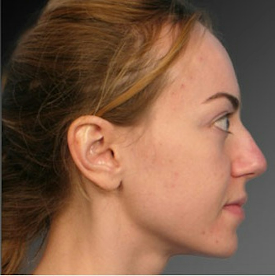 Patient 106009312 | Profile View | Before | Rhinoplasty — Steven Teitelbaum MD -
