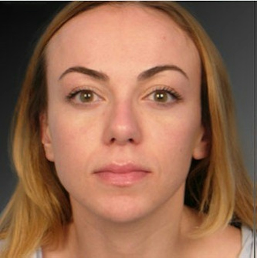 Patient 106009312 | Front View | After | Rhinoplasty — Steven Teitelbaum MD -