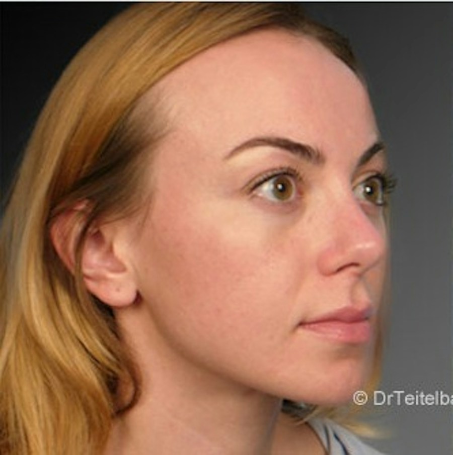 Patient 106009312 | Angle View | After | Rhinoplasty — Steven Teitelbaum MD -