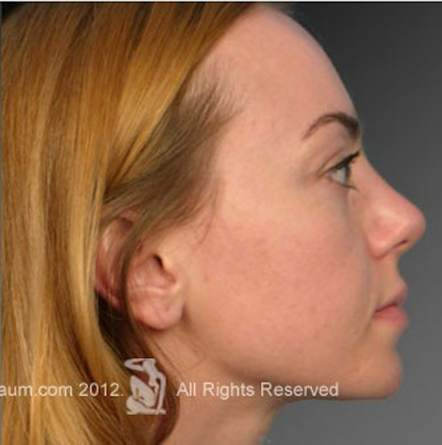 Patient 106009312 | Profile View | After | Rhinoplasty — Steven Teitelbaum MD -