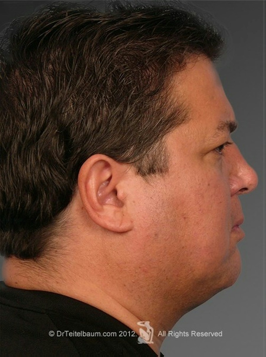 Patient 106009394 | Profile View | After | Chin Augmentation — Steven Teitelbaum MD - Santa Monica