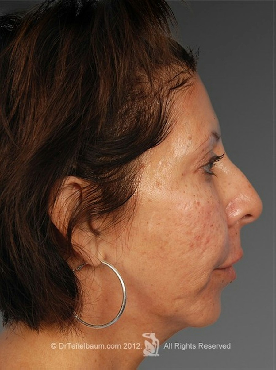 Patient 106009395 | Profile View | After | Chin Augmentation — Steven Teitelbaum MD - Santa Monica