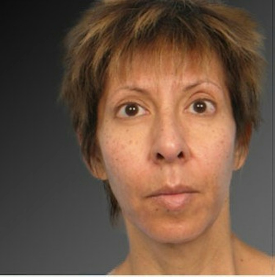 Patient 106009396 | Front View | Before | Chin Augmentation — Steven Teitelbaum MD -