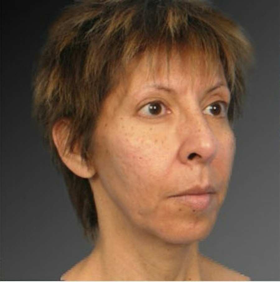Patient 106009396 | Angle View | Before | Chin Augmentation — Steven Teitelbaum MD -