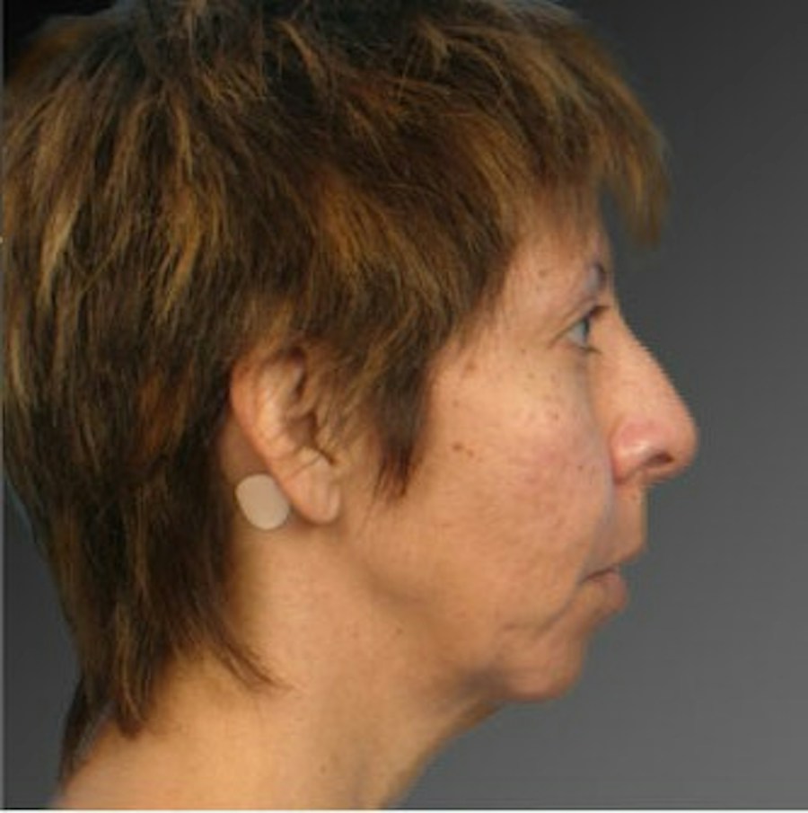 Patient 106009396 | Profile View | Before | Chin Augmentation — Steven Teitelbaum MD -