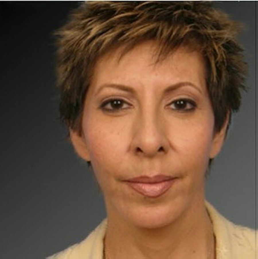 Patient 106009396 | Front View | After | Chin Augmentation — Steven Teitelbaum MD -