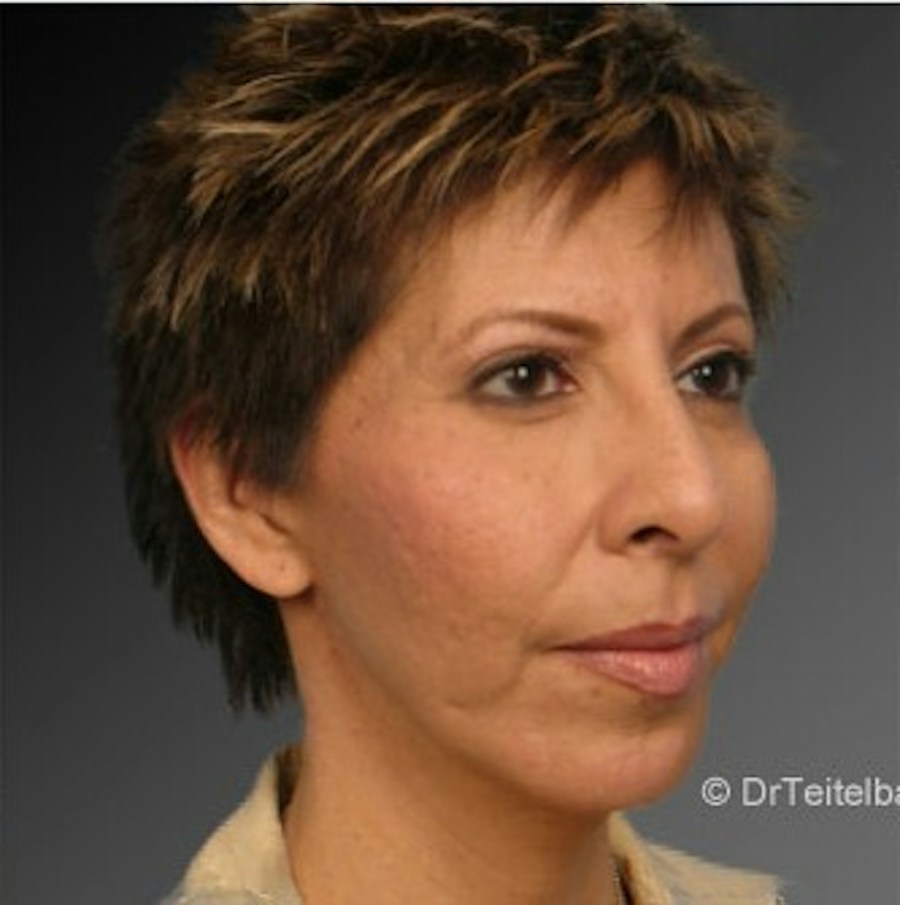 Patient 106009396 | Angle View | After | Chin Augmentation — Steven Teitelbaum MD -