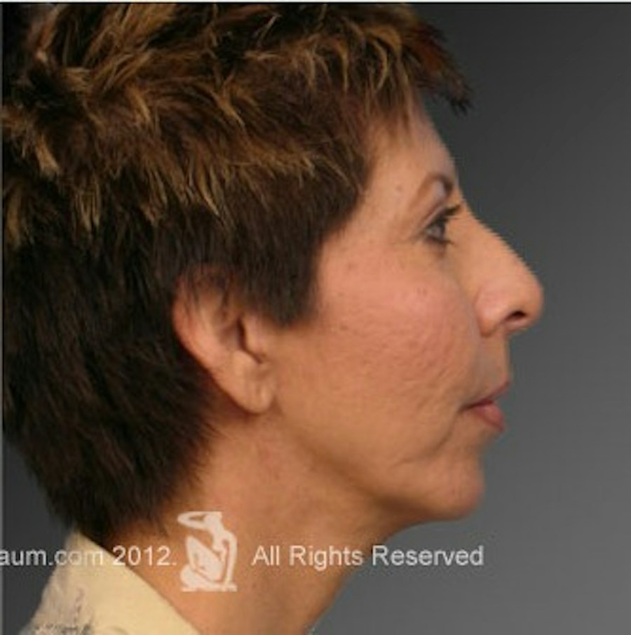 Patient 106009396 | Profile View | After | Chin Augmentation — Steven Teitelbaum MD -