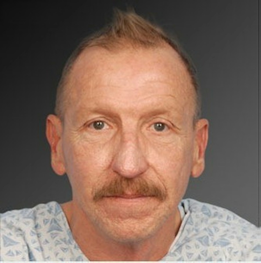 Patient 106009398 | Front View | Before | Men's Face — Steven Teitelbaum MD -