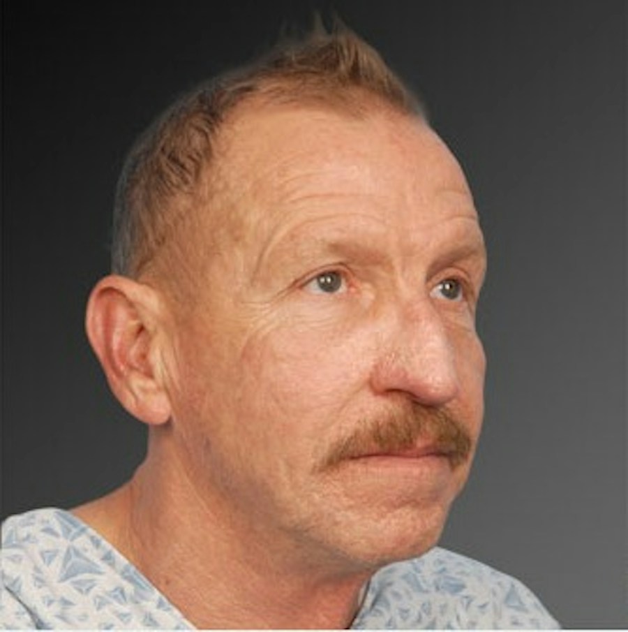 Patient 106009398 | Angle View | Before | Men's Face — Steven Teitelbaum MD -