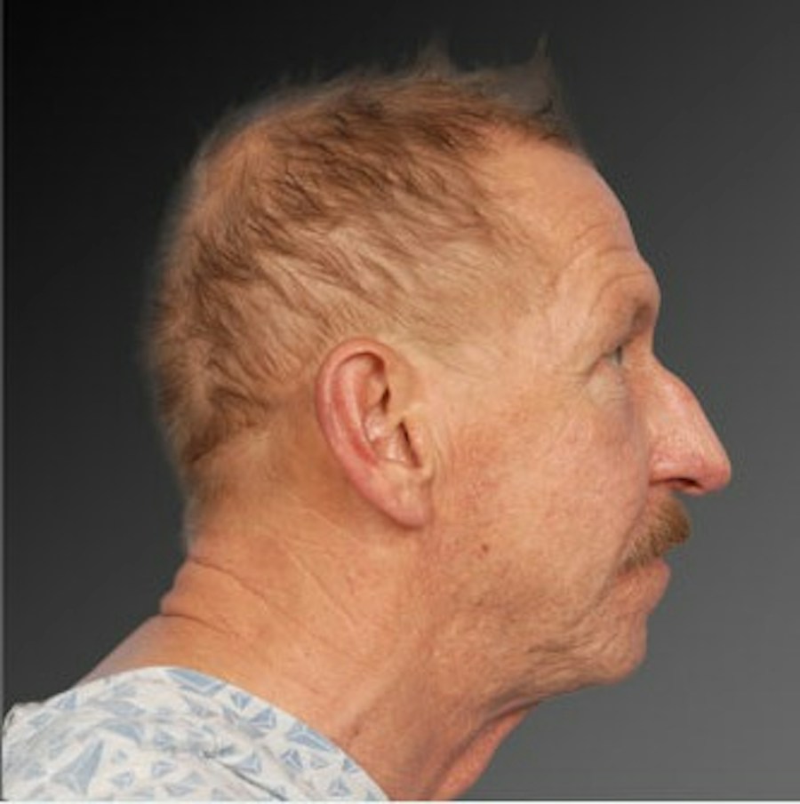 Patient 106009398 | Profile View | Before | Men's Face — Steven Teitelbaum MD -