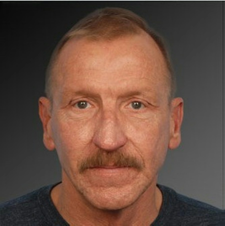 Patient 106009398 | Front View | After | Chin Augmentation — Steven Teitelbaum MD - Santa Monica