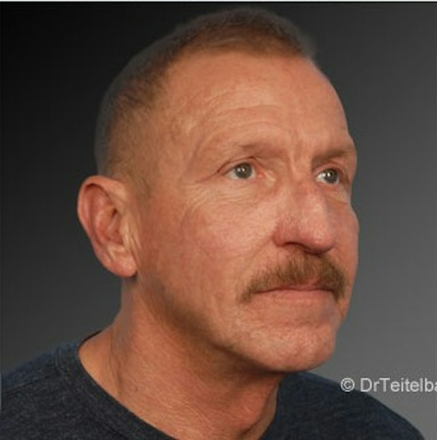 Patient 106009398 | Angle View | After | Men's Face — Steven Teitelbaum MD -