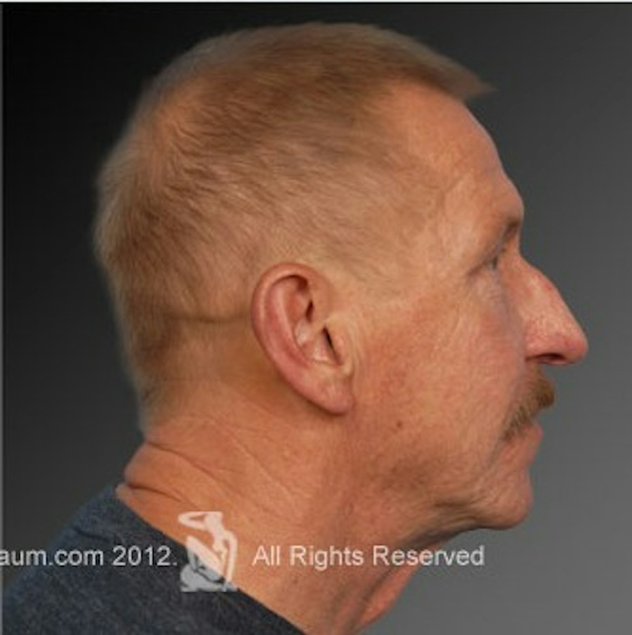Patient 106009398 | Profile View | After | Men's Face — Steven Teitelbaum MD -
