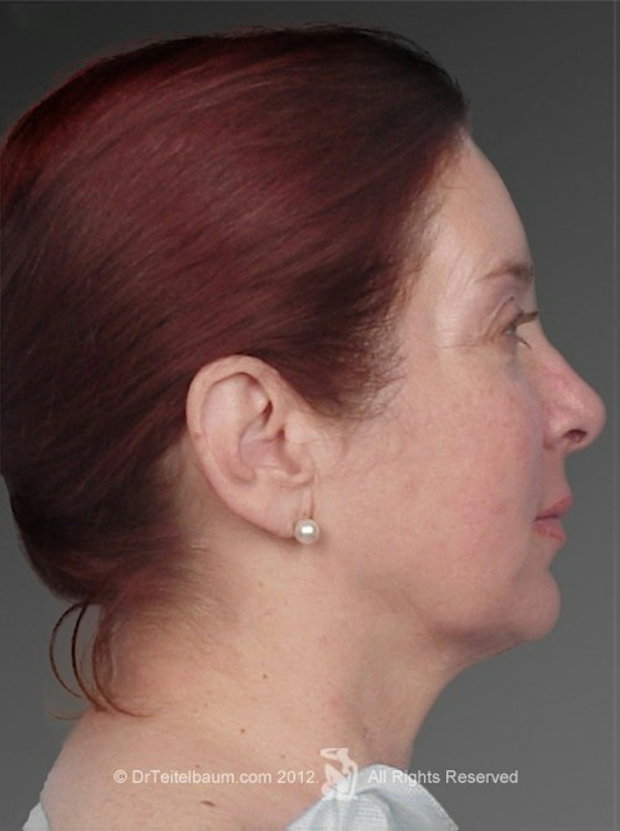 Patient 106017402 | Profile View | After | Chin Augmentation — Steven Teitelbaum MD - Santa Monica