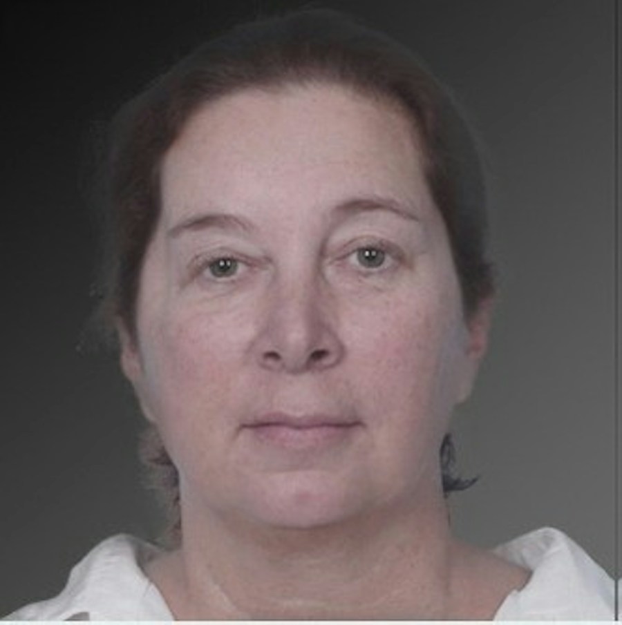 Patient 106038105 | Front View | Before | Chin Augmentation — Steven Teitelbaum MD -