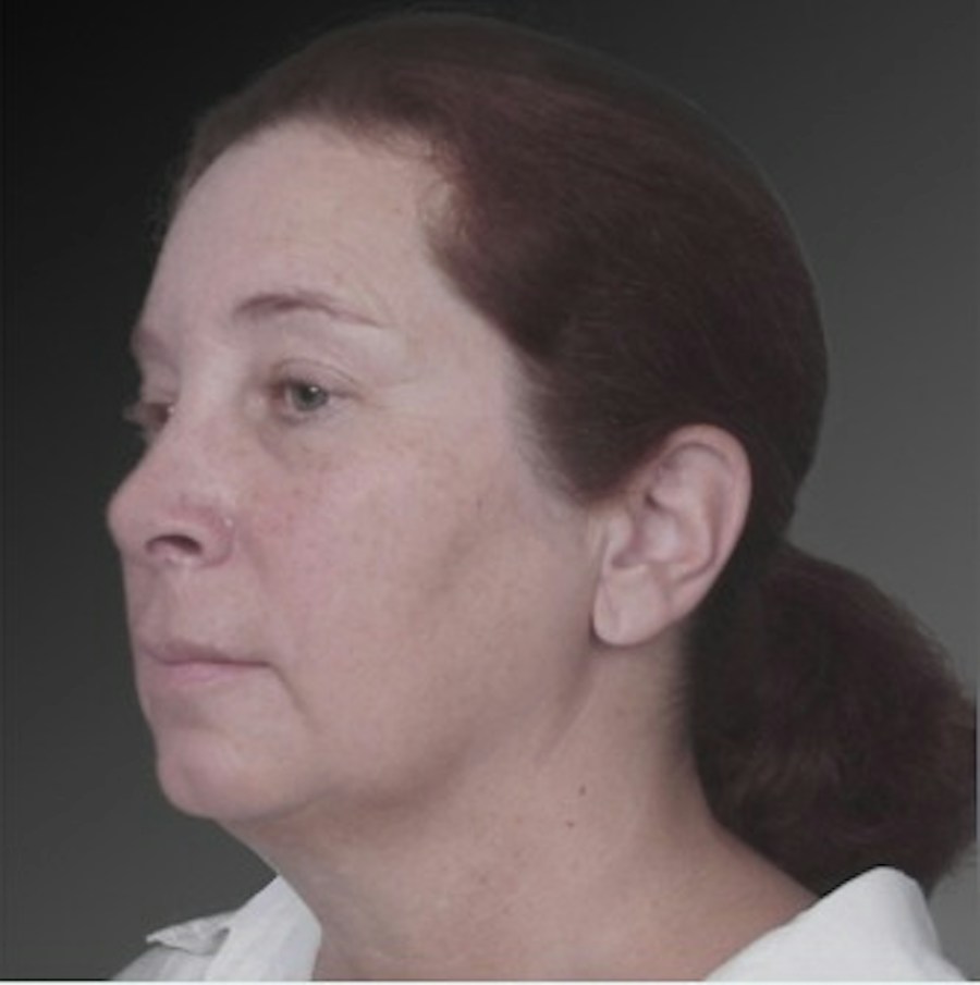 Patient 106038105 | Angle View | Before | Chin Augmentation — Steven Teitelbaum MD -