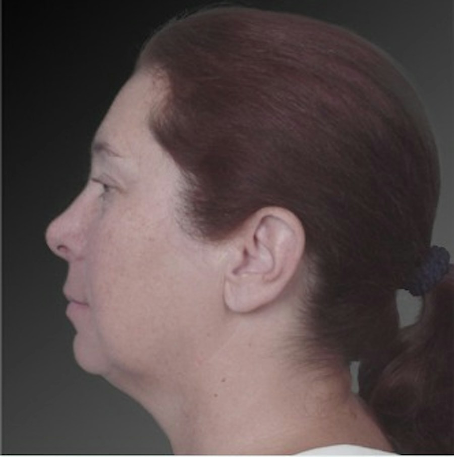 Patient 106038105 | Profile View | Before | Chin Augmentation — Steven Teitelbaum MD -