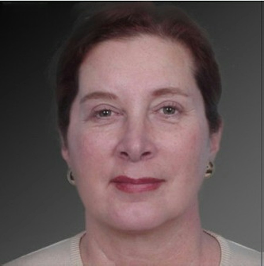 Patient 106038105 | Front View | After | Chin Augmentation — Steven Teitelbaum MD -