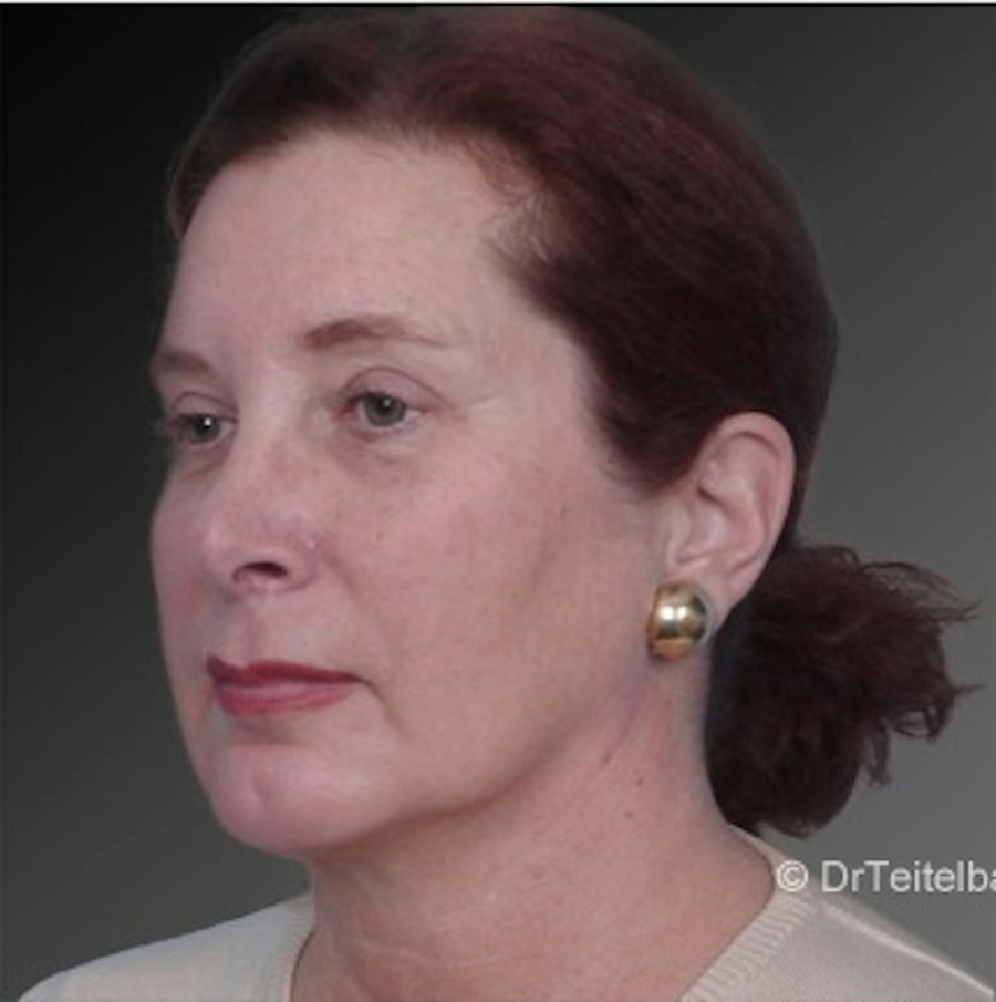 Patient 106038105 | Angle View | After | Chin Augmentation — Steven Teitelbaum MD -