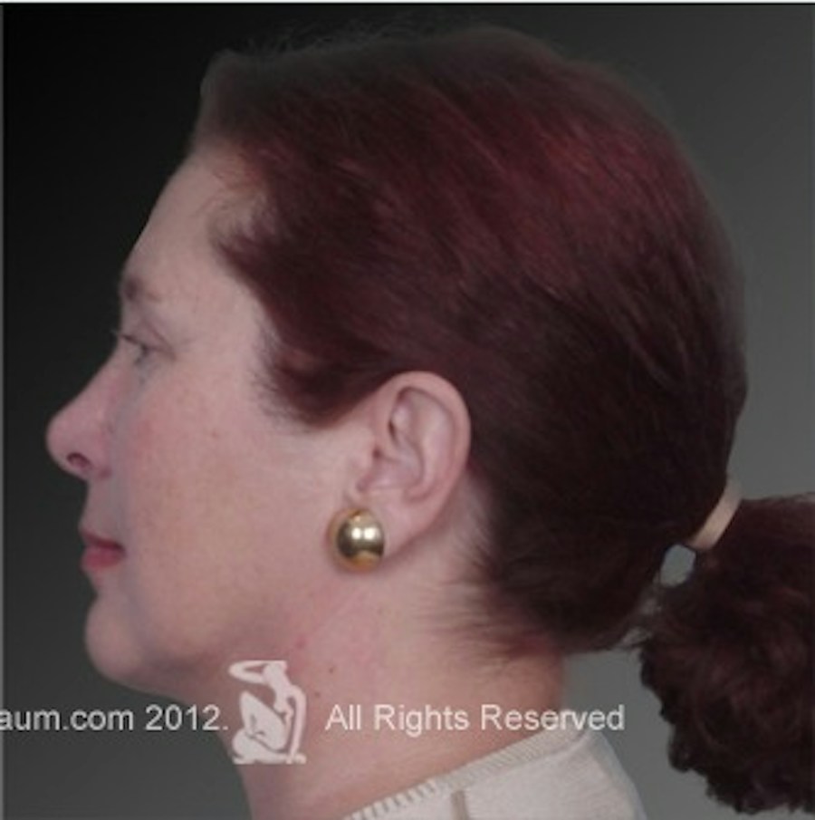 Patient 106038105 | Profile View | After | Chin Augmentation — Steven Teitelbaum MD -
