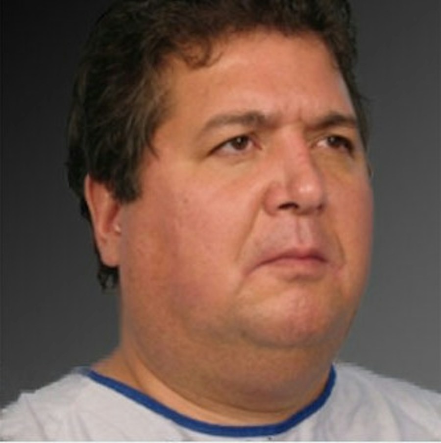 Patient 106038106 | Angle View | Before | Men's Face — Steven Teitelbaum MD -