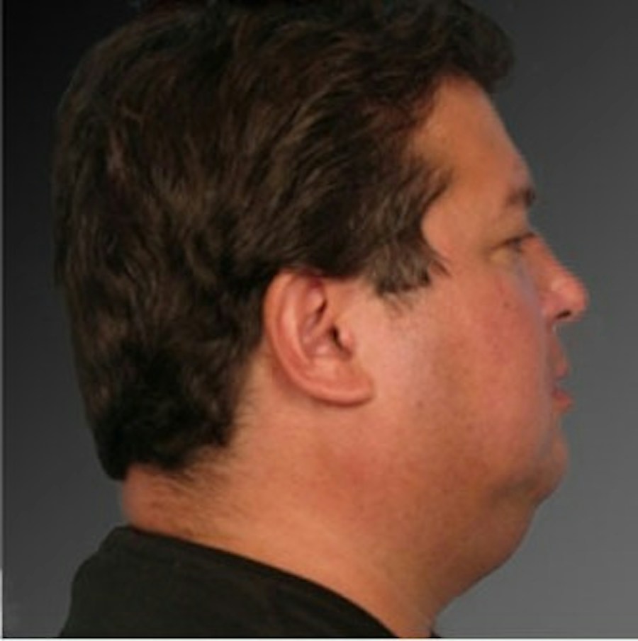 Patient 106038106 | Profile View | Before | Men's Face — Steven Teitelbaum MD -
