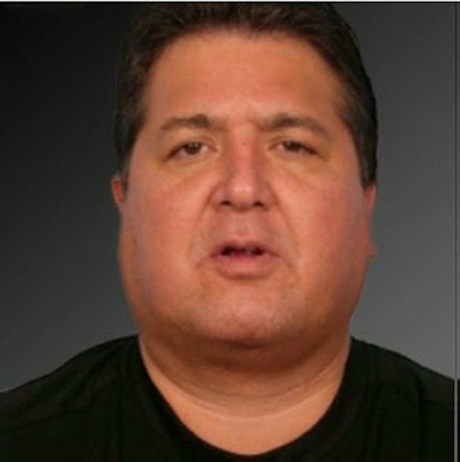 Patient 106038106 | Front View | After | Men's Face — Steven Teitelbaum MD -