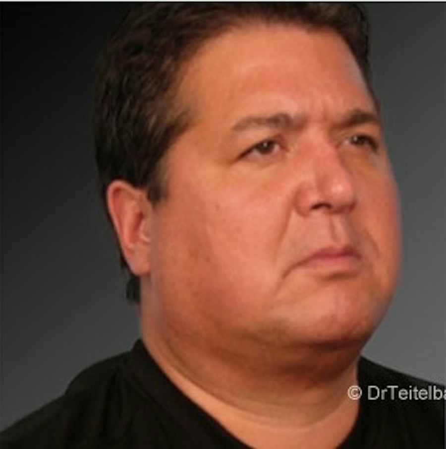 Patient 106038106 | Angle View | After | Men's Face — Steven Teitelbaum MD -