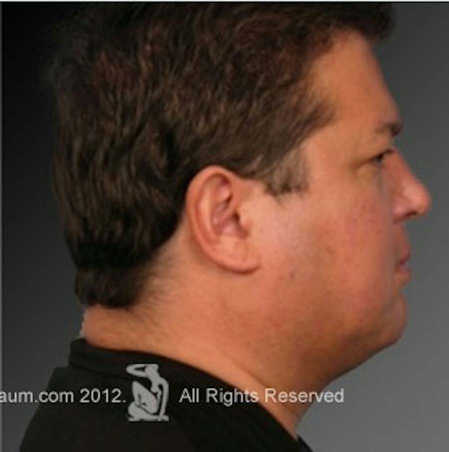 Patient 106038106 | Profile View | After | Men's Face — Steven Teitelbaum MD -