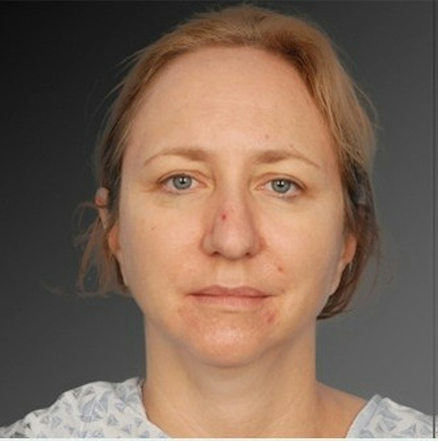 Patient 106038107 | Front View | Before | Chin Augmentation — Steven Teitelbaum MD -