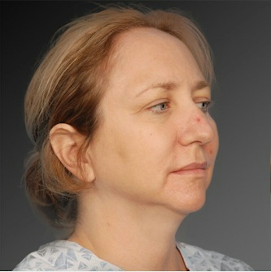 Patient 106038107 | Angle View | Before | Chin Augmentation — Steven Teitelbaum MD -