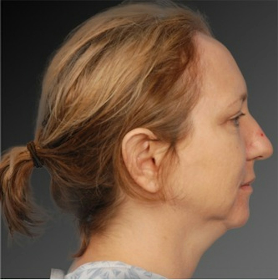 Patient 106038107 | Profile View | Before | Chin Augmentation — Steven Teitelbaum MD -