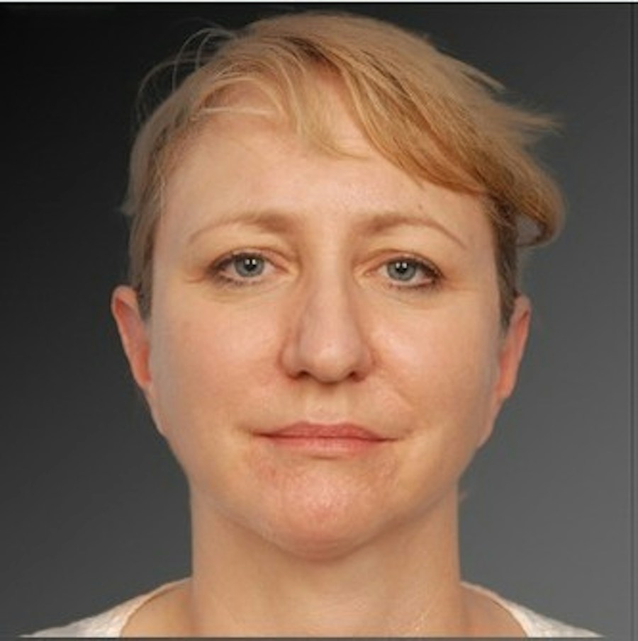 Patient 106038107 | Front View | After | Neck Liposuction — Steven Teitelbaum MD - Santa Monica