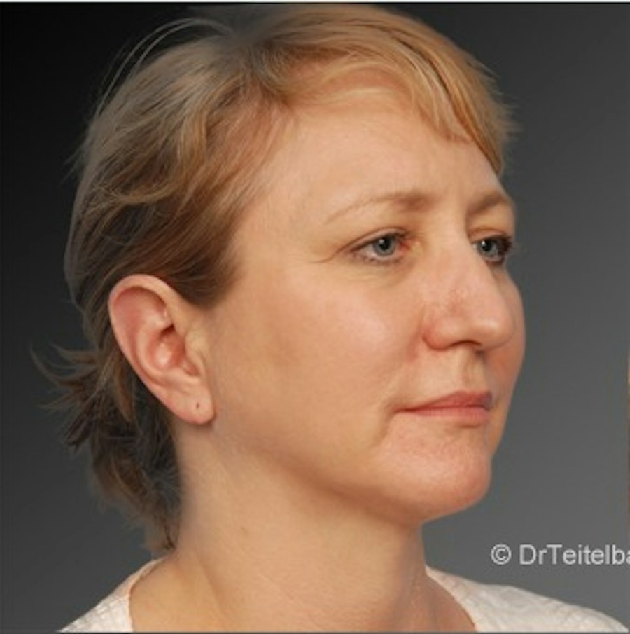 Patient 106038107 | Angle View | After | Chin Augmentation — Steven Teitelbaum MD -
