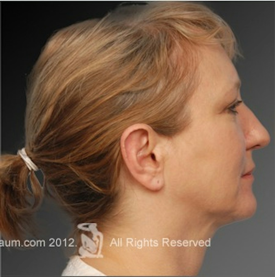 Patient 106038107 | Profile View | After | Chin Augmentation — Steven Teitelbaum MD -