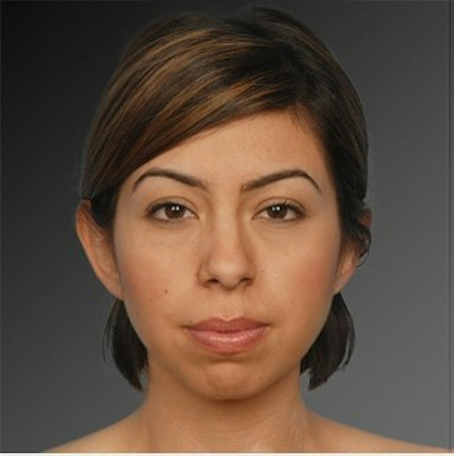 Patient 106038110 | Front View | Before | Chin Augmentation — Steven Teitelbaum MD -