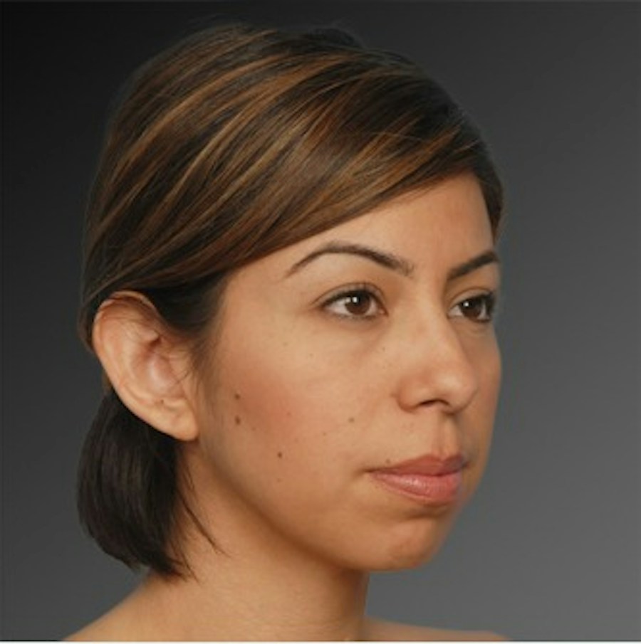Patient 106038110 | Angle View | Before | Chin Augmentation — Steven Teitelbaum MD -